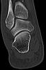 Broken Fibula by Ankle, Shattered Rear Glass-derf-broken-fibula-front-view-r-ankle-ct.jpg